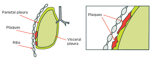 [image] Diagram showing pleural plaques