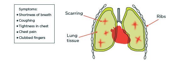[image] Diagram showing asbestosis scarring on lung